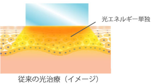 従来の光治療(イメージ)