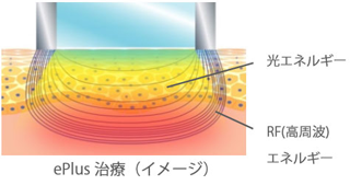 ePlus治療