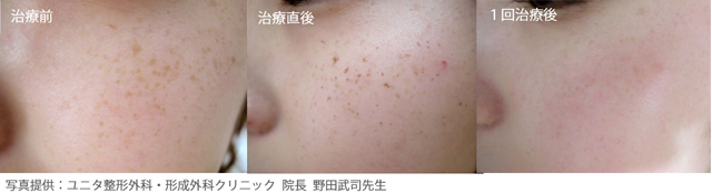 写真提供:Syneron 社