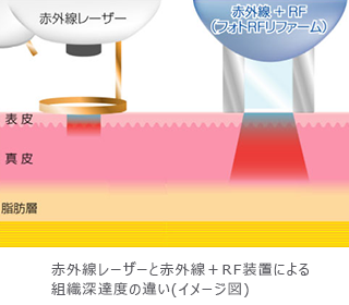 赤外線レーザーと赤外線＋RF装置による組織深達度の違い(イメージ図)